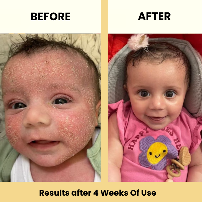 Beezema Baby Eczema Cream