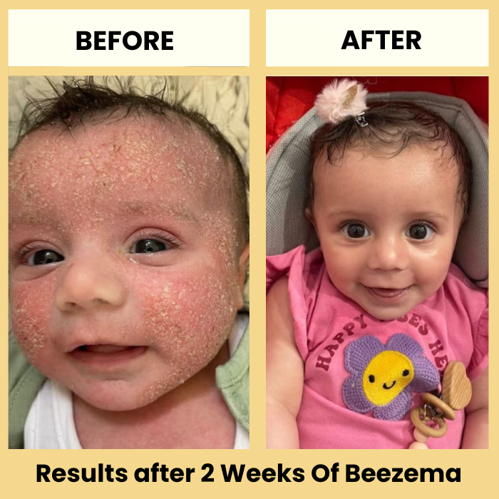 Beezema Baby Eczema Cream