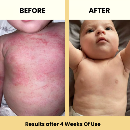 Beezema Baby Eczema Cream