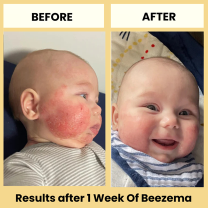 Beezema Baby Eczema Cream