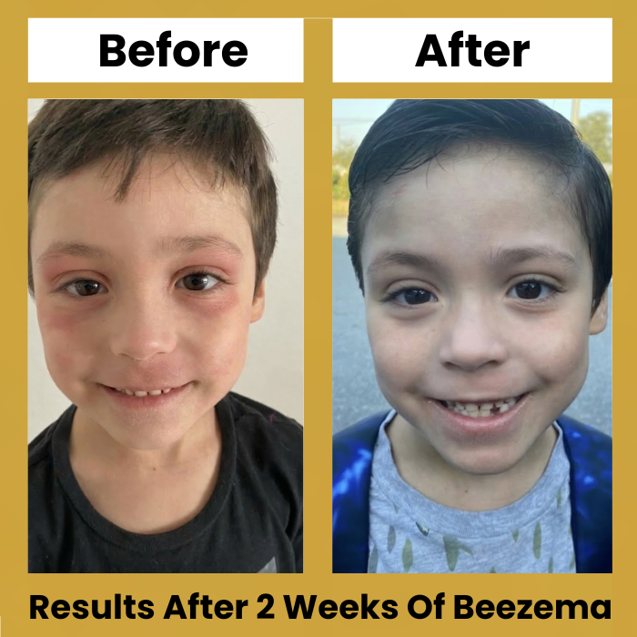 Beezema Childrens Eczema Cream