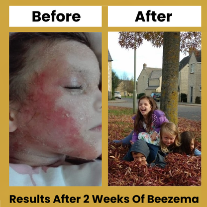 Beezema Childrens Eczema Cream