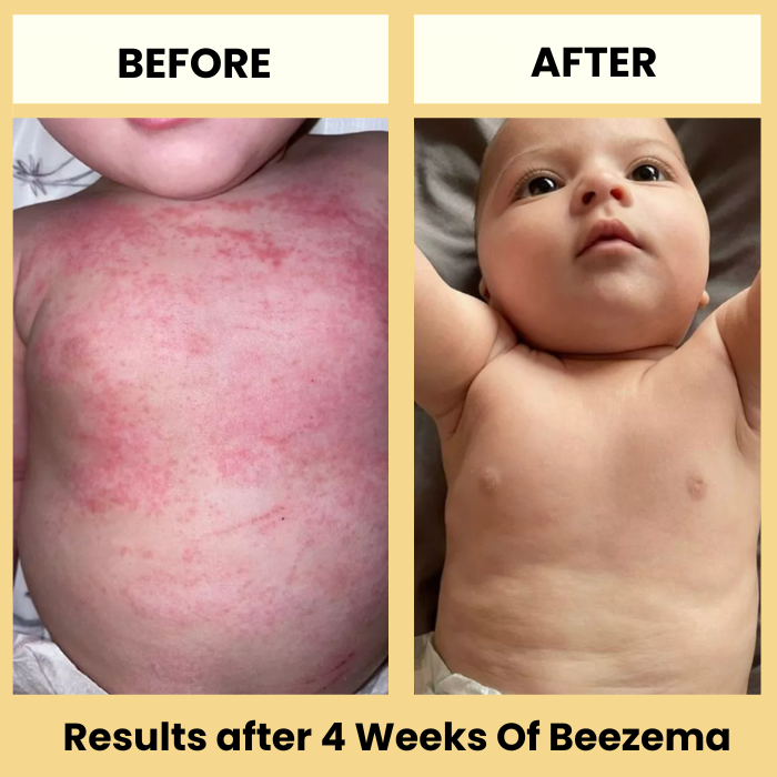 Beezema Baby Eczema Cream